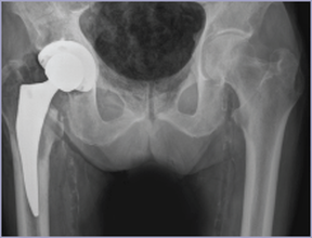 Mako Robot X ray post surgery